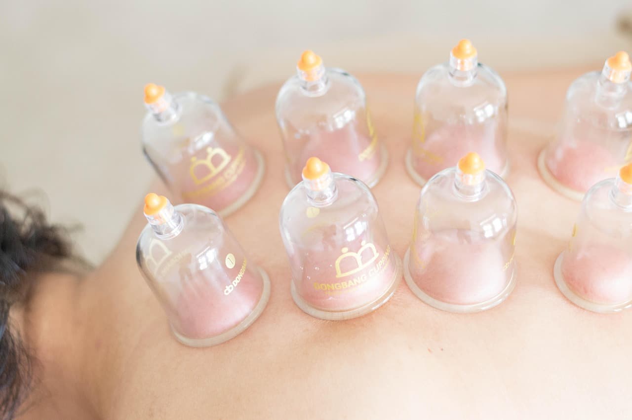 Cupping therapy cups on a patient's back